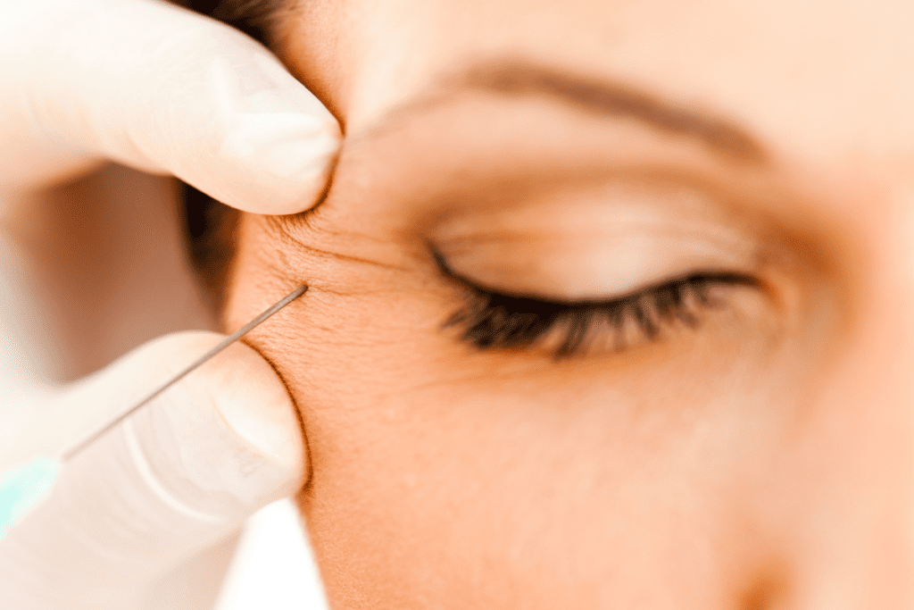 Botox injections