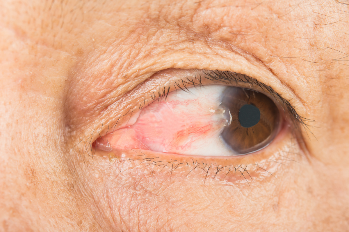 Pterygium Pterygium