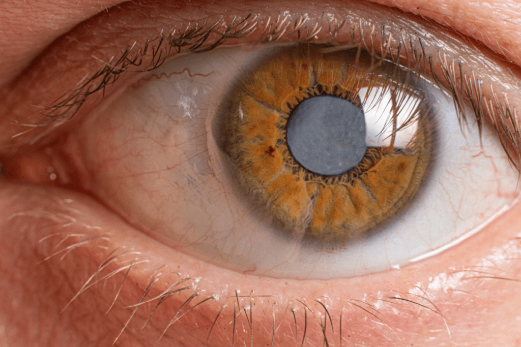 Cataract and Diabetes: Symptoms, Causes and Treatment
