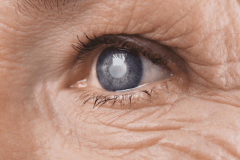 glaucoma