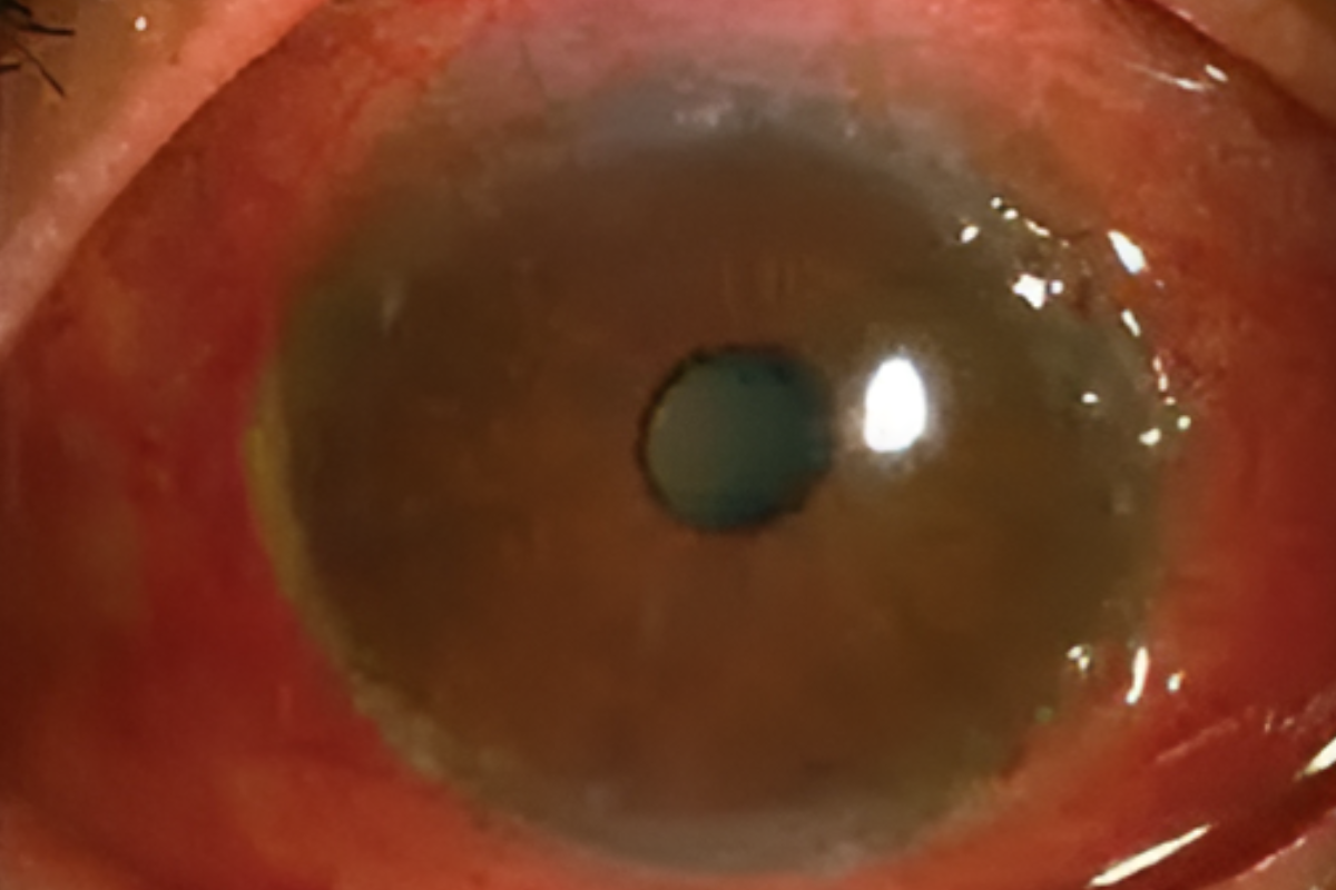 immature senile cataract iris shadow Images High... Difference Between Mature and Immature Cataracts