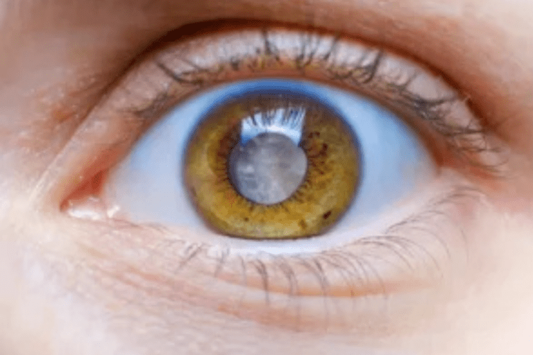 mature cataract