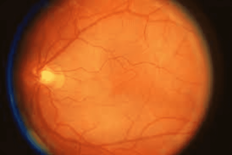 Cystoid Macular Edema (CME)