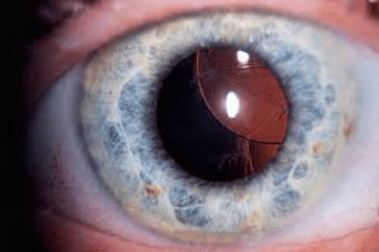 Dislocated or Misaligned IOL