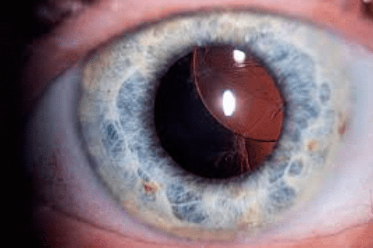 Dislocated or Shifted Intraocular Lens (IOL)