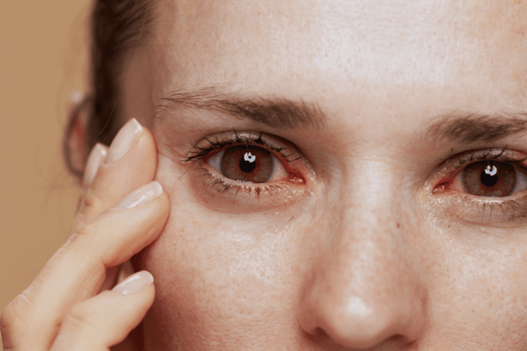 Dry eyes