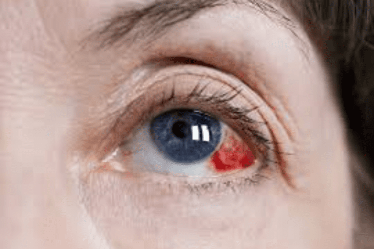 Ocular hypertension
