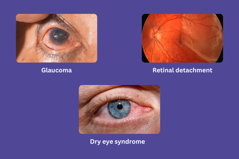 Other eye conditions post-surgery
