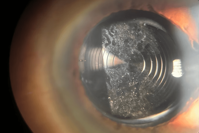 Posterior Capsular Opacification (PCO)