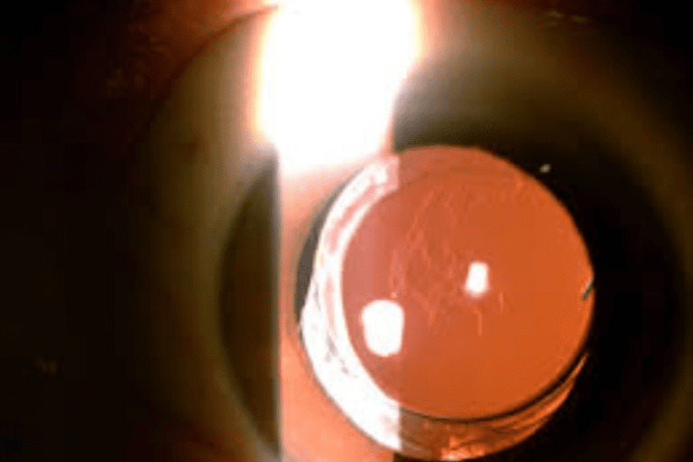 Posterior Capsular Opacification (PCO)
