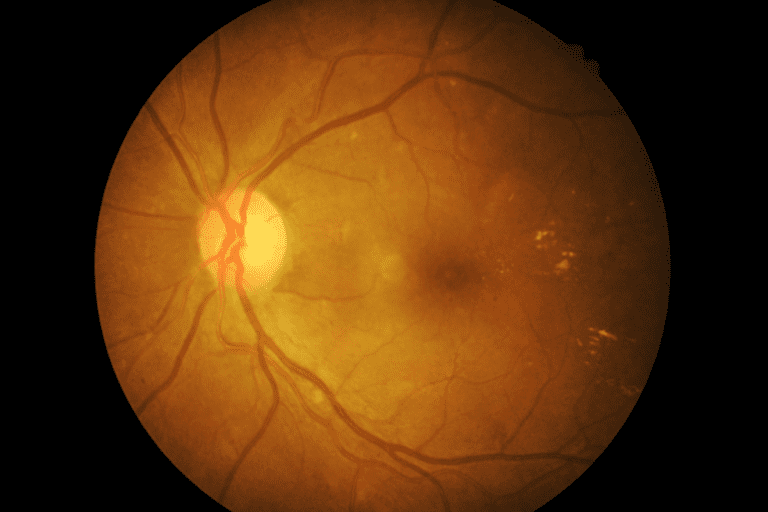 Retinal detachment