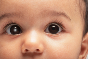 Pediatric cataract surgery: Everything parents need to know