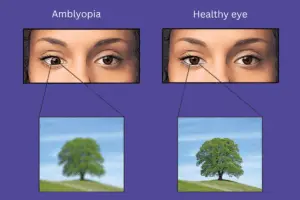 Amblyopia