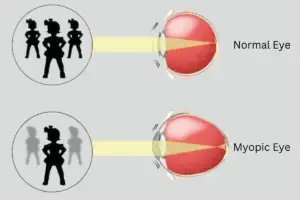 Myopia (Nearsightedness)