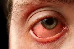Redness in the eye