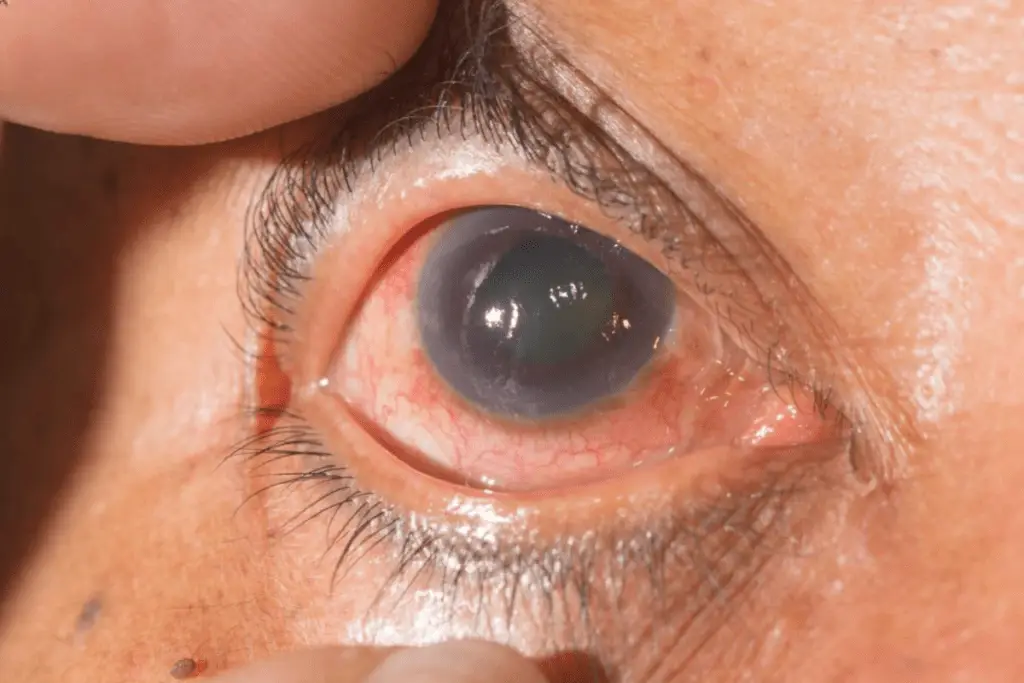 Symptoms of glaucoma