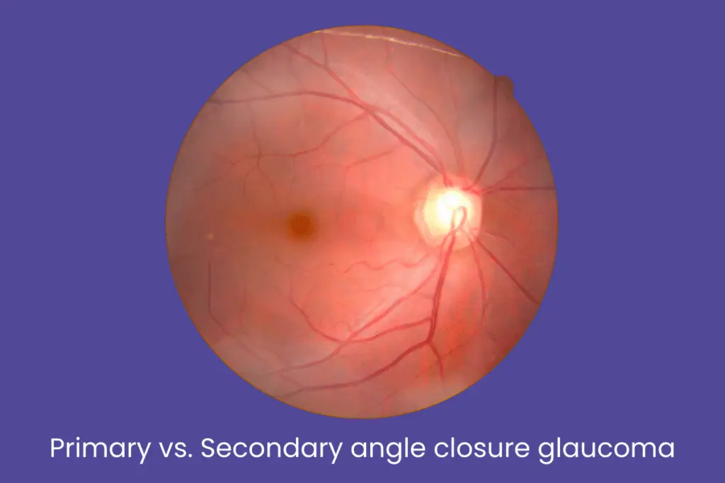 Primary vs. Secondary angle closure glaucoma