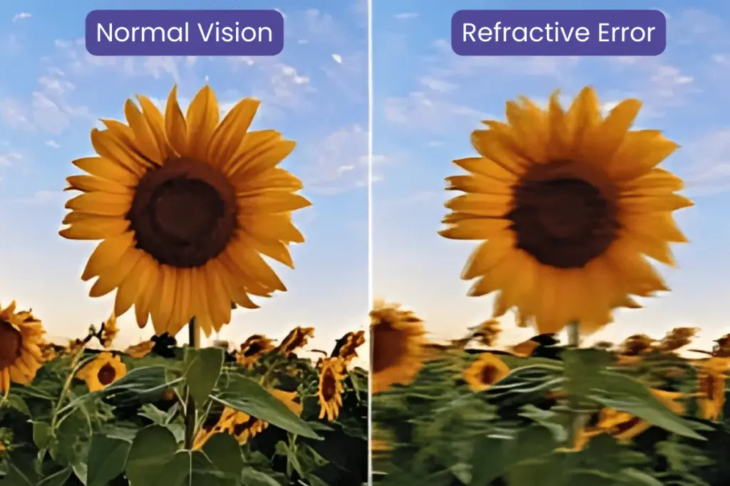 Refractive errors