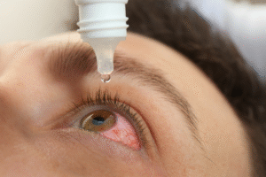 Dry eyes after cataract surgery