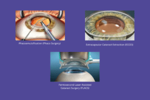 Types of cataract surgery explained: Benefits and Limitations