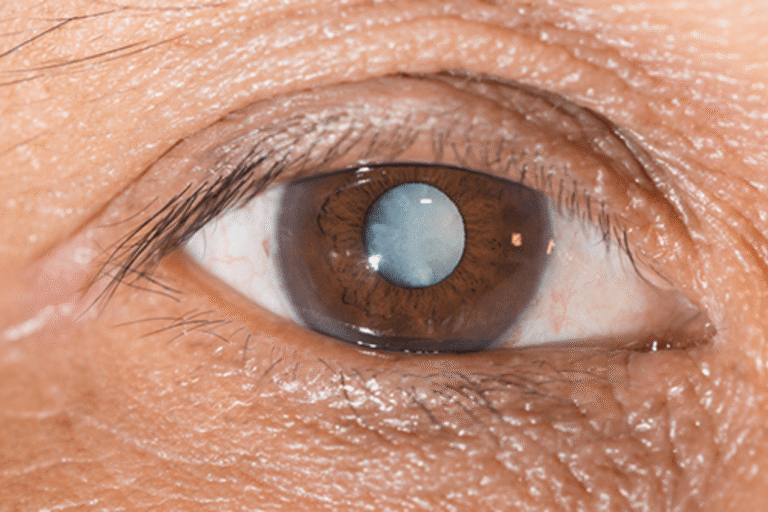 Cataract surgery in patients with glaucoma