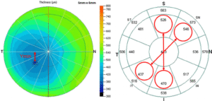 Pre-surgical imaging to map your eye precisely
