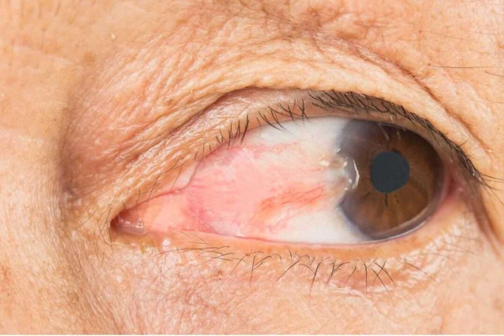 Pterygium: Symptoms, Causes, and Modern treatment options