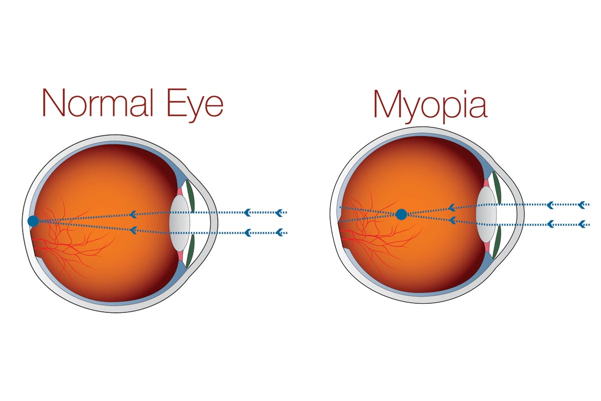 What to expect during and after myopia surgery?