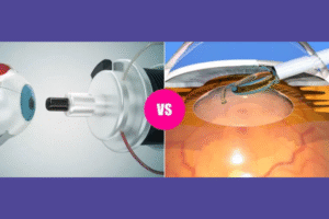 LASIK eye surgery Vs Contact lenses