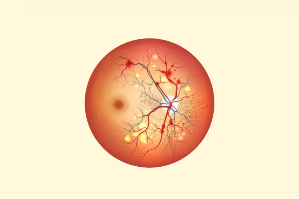 Diabetic Retinopathy: Early signs you should never ignore