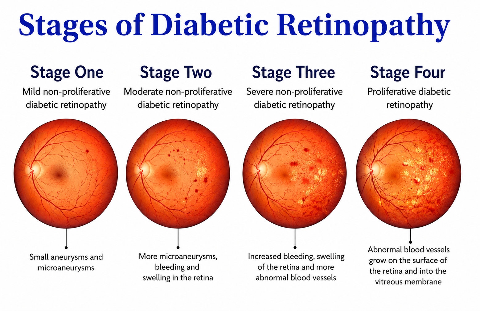 Comparison showing a healthy retina and a retina affected by diabetic retinopathy with visible damage