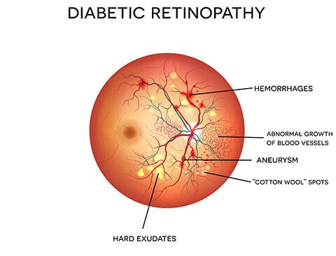 Diabetic retinopathy eye diagram showing haemorrhages, abnormal blood vessel growth and hard exudates on the retina