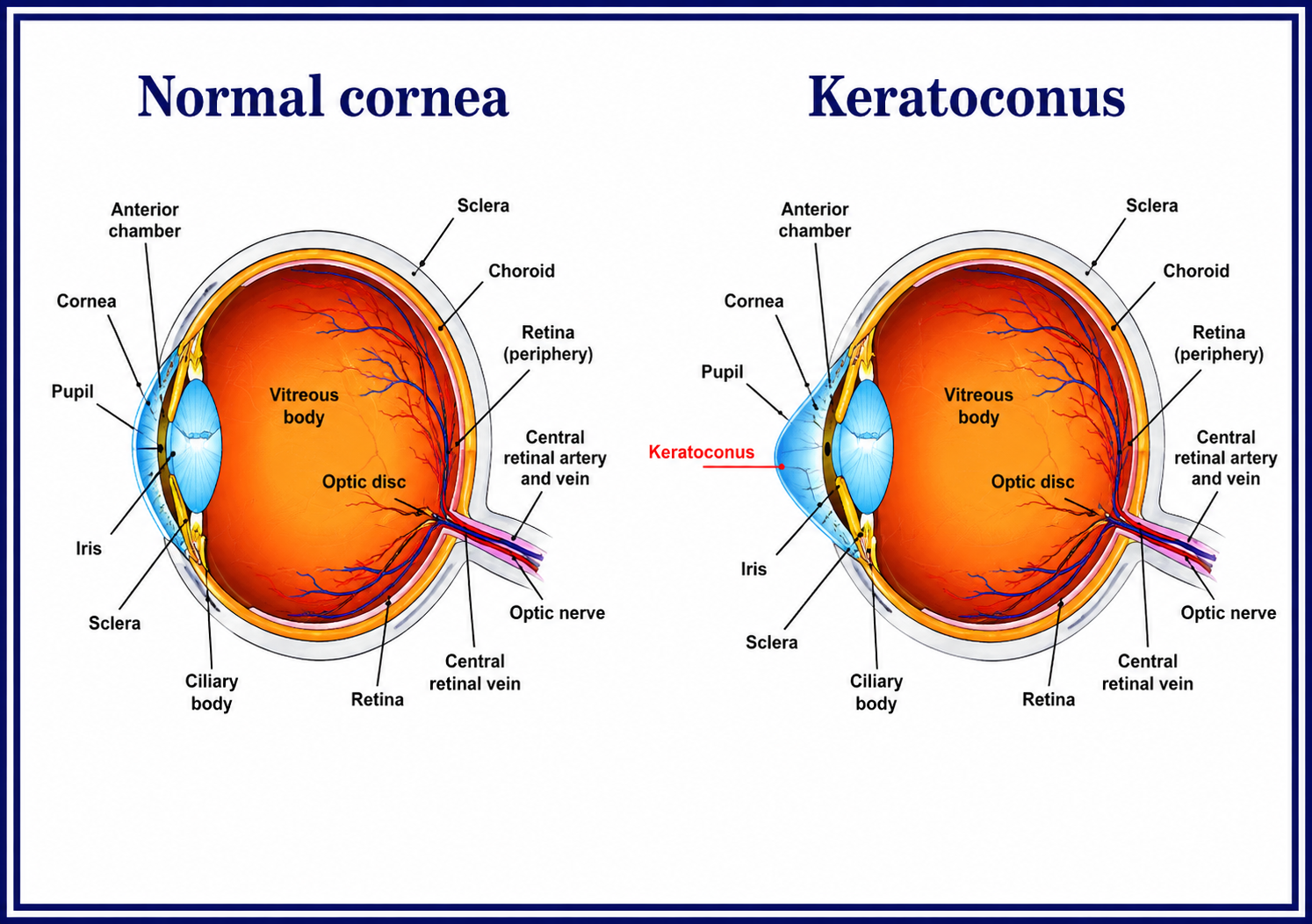 Cross-section diagram showing corneal cross-linking procedure for keratoconus treatment
