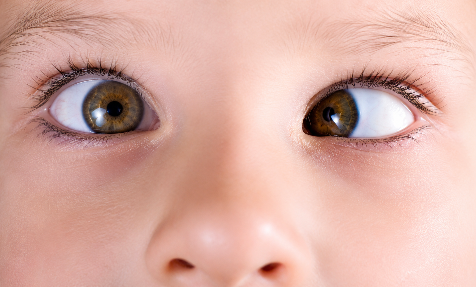 Child with squint showing eye misalignment, squint treatment in Ahmedabad at Krisha Eye Hospital