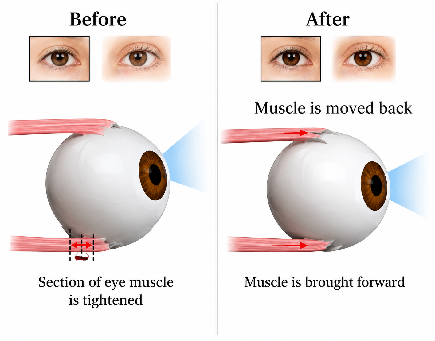 Squint surgery diagram showing eye muscle repositioning, strabismus surgery in Ahmedabad