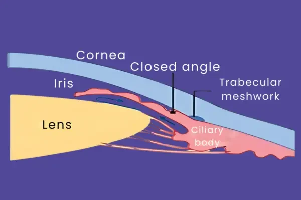 Primary Angle Closure Glaucoma (PACG) Primary Angle Closure Glaucoma (PACG)