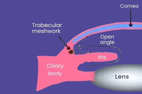 Secondary angle closure glaucoma Secondary angle closure glaucoma